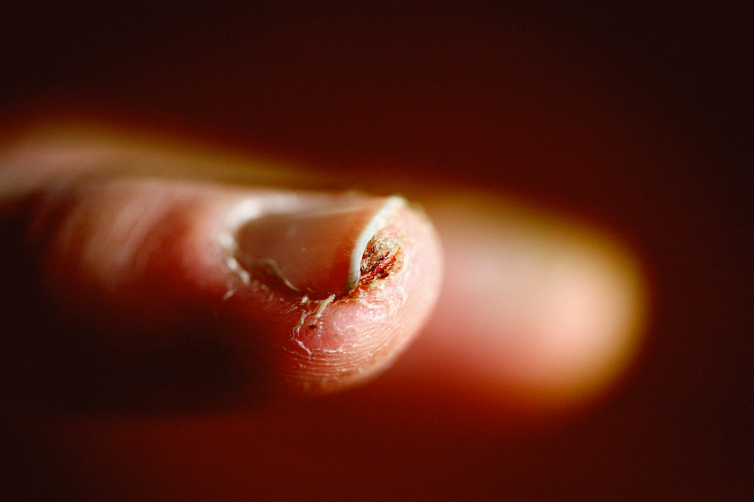 Fungal Nail Infections: What Causes Them and Why They're Hard to Treat